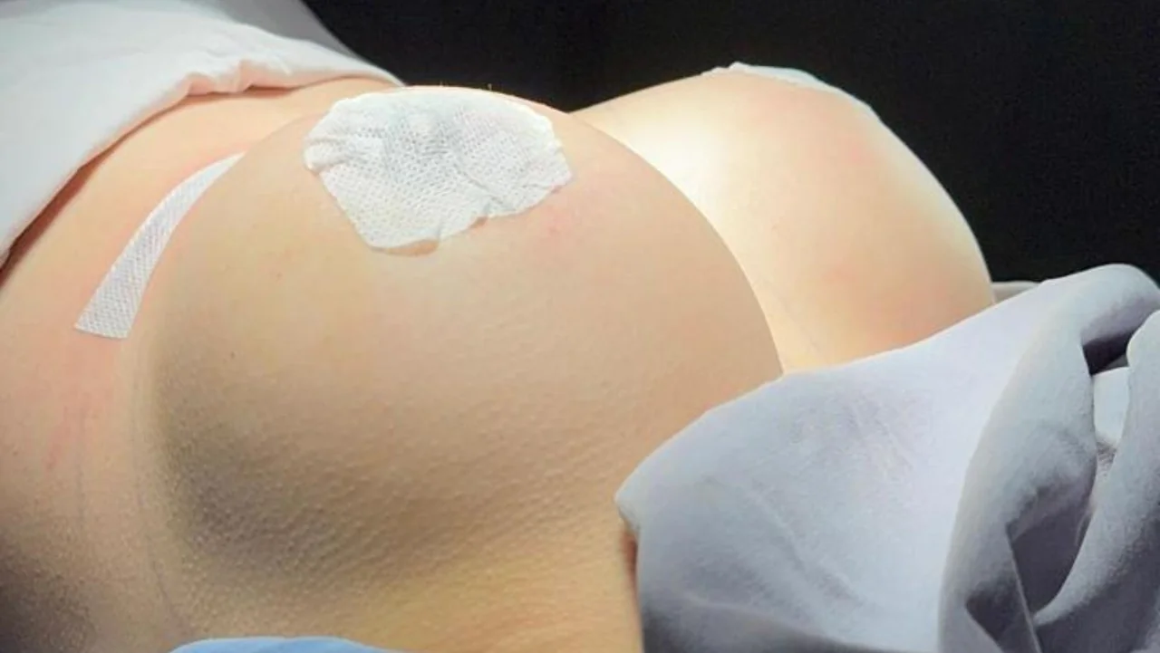 Implantes mamarios: seguridad y excelencia médica